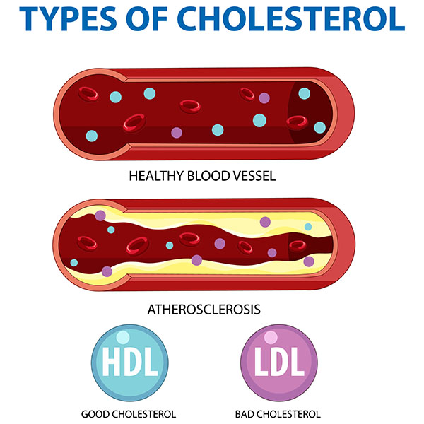 Infographics about Types of cholesterol LDL and HDL.